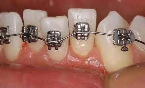 Imagem de dentes com aparelho ortodôntico fixo e brackets de metal e fios ortodônticos, destacando o uso comum para correção de alinhamento dental, ideal para quem busca melhorar o sorriso.
