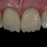Imagem mostrando dentes com problemas de alinhamento e desgaste, ideal para conteúdo relacionado à saúde bucal e odontologia.