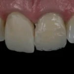 Imagem de dentes com problema de alinhamento e manchas, indicando necessidade de tratamento odontológico. Ortodontia e estética dental.