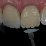 Imagem de dentes naturais e branqueados mostrando a anatomia da arcada dentária com detalhes bem visíveis, foco na saúde bucal e estética dental.