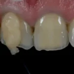 Imagem de dentes com cáries, torções e estado de desenvolvimento alterado, evidenciando problemas dentários que requerem atenção odontológica especializada.