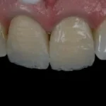 Imagem de dentes com problemas de alinhamento, com alguns dentes brancos e outros amarelados e desgastados, indicando necessidade de tratamento odontológico.