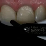 Imagem de dentes naturais sendo analisados com um instrumento odontológico, indicando avaliação e cuidado com a saúde bucal.