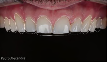 Imagem de um sorriso com dentes brancos e bem alinhados, destacando a sa&uacute;de bucal e a est&eacute;tica dental, ideal para quem busca melhorar o sorriso por meio de procedimentos odontol&oacute;gicos.