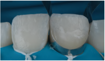 Dentes restaurados com resina composta, mostrando acabamento natural e processo de montagem odontol&oacute;gica, ideal para melhorias est&eacute;ticas e funcionais.