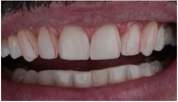 Imagem de sorriso com dentes limpos e brancos, destacando uma higiene bucal adequada e sorriso saud&aacute;vel.