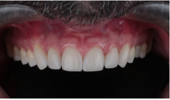 Sorriso com dentes brancos e gengiva rosada, mostrando uma sa&uacute;de bucal adequada, ideal para quem busca dicas de higiene oral.