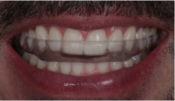 Sorriso com dentes brancos e alinhados, destacando uma denti&ccedil;&atilde;o saud&aacute;vel e bem cuidada, ideal para quem busca melhorar a est&eacute;tica dental e manter uma boa higiene bucal.