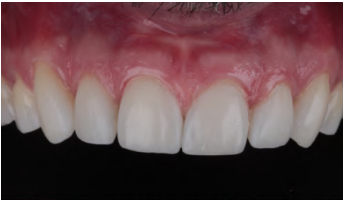 Imagem de sorriso com dentes saud&aacute;veis e gengiva bem cuidada, destacando a import&acirc;ncia da higiene bucal para uma sa&uacute;de bucal perfeita.