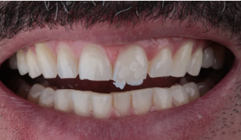 Close-up de um sorriso com dentes desalinhados e uma lacuna vis&iacute;vel entre os dentes superiores e inferiores, evidenciando problemas dentais e de alinhamento.