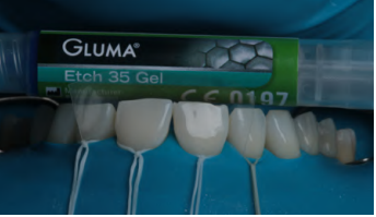 Imagem de v&aacute;rias coroas dentais de porcelana alinhadas em uma embalagem de pasta de cimento dent&aacute;rio Gluma Etch 35 Gel, que &eacute; usada na coloca&ccedil;&atilde;o de coroas, pontes e outros tratamentos odontol&oacute;gicos est&eacute;ticos.