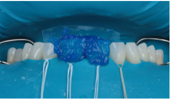 Imagem de um procedimento odontol&oacute;gico com moldes e materiais na boca, focado em tratamentos dent&aacute;rios para melhorar a sa&uacute;de oral e a est&eacute;tica do sorriso.
