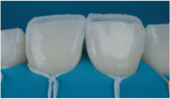 Imagem de dentes de resina para coroa dental, mostrando detalhes do material utilizado na est&eacute;tica e funcionalidade do tratamento odontol&oacute;gico.