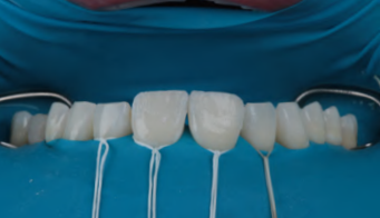 Imagem de um procedimento de clareamento dental com moldeira e subst&acirc;ncia clareadora, destacando a est&eacute;tica do sorriso e a sa&uacute;de bucal.