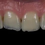 Imagem mostrando dentes com problemas de esmalte e possível desgaste dental, ideal para tratamentos odontológicos e estética dental.