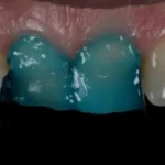 Imagem de dente com tratamento odontológico, possivelmente com aplicação de uma resina ou outro procedimento restaurador, visto na região anterior do sorriso.