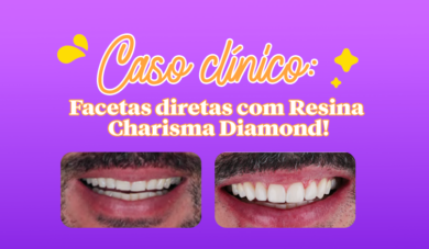 Facetas diretas de Resina: Opção rápida, estética e longeva – Relato de Caso
