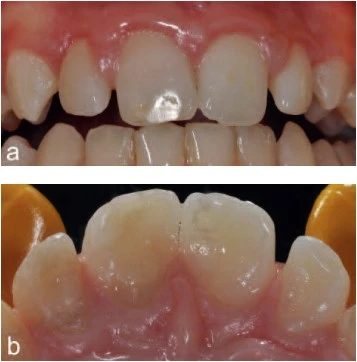 Raio-x de dentes apresentando cáries, obturações e estrutura óssea bucal, ideal para avaliação odontológica precisa e diagnóstico de problemas dentais.