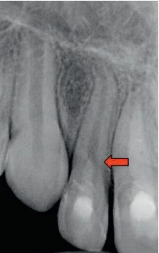 Raio-X mostrando dente comprometido e necessidade de tratamento odontológico, com destaque para cárie ou infecção na raiz. Imagem de exame bucal detectando problemas dentários.