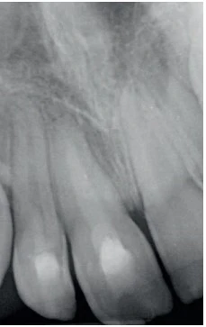 Imagem de uma radiografia dental mostrando dentes superiores e inferiores, com foco na estrutura óssea e dentes. Ferramenta importante para diagnósticos odontológicos precisos.