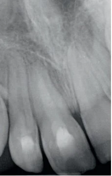 Raio-x de dentes apresentando cáries, obturações e estrutura óssea bucal, ideal para avaliação odontológica precisa e diagnóstico de problemas dentais.