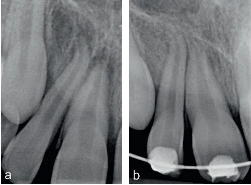 Imagem de raio-X odontológico mostrando tratamento com aparelho ortodôntico fixo, incluindo brackets e arames, recomendado para correção dentária e alinhamento.