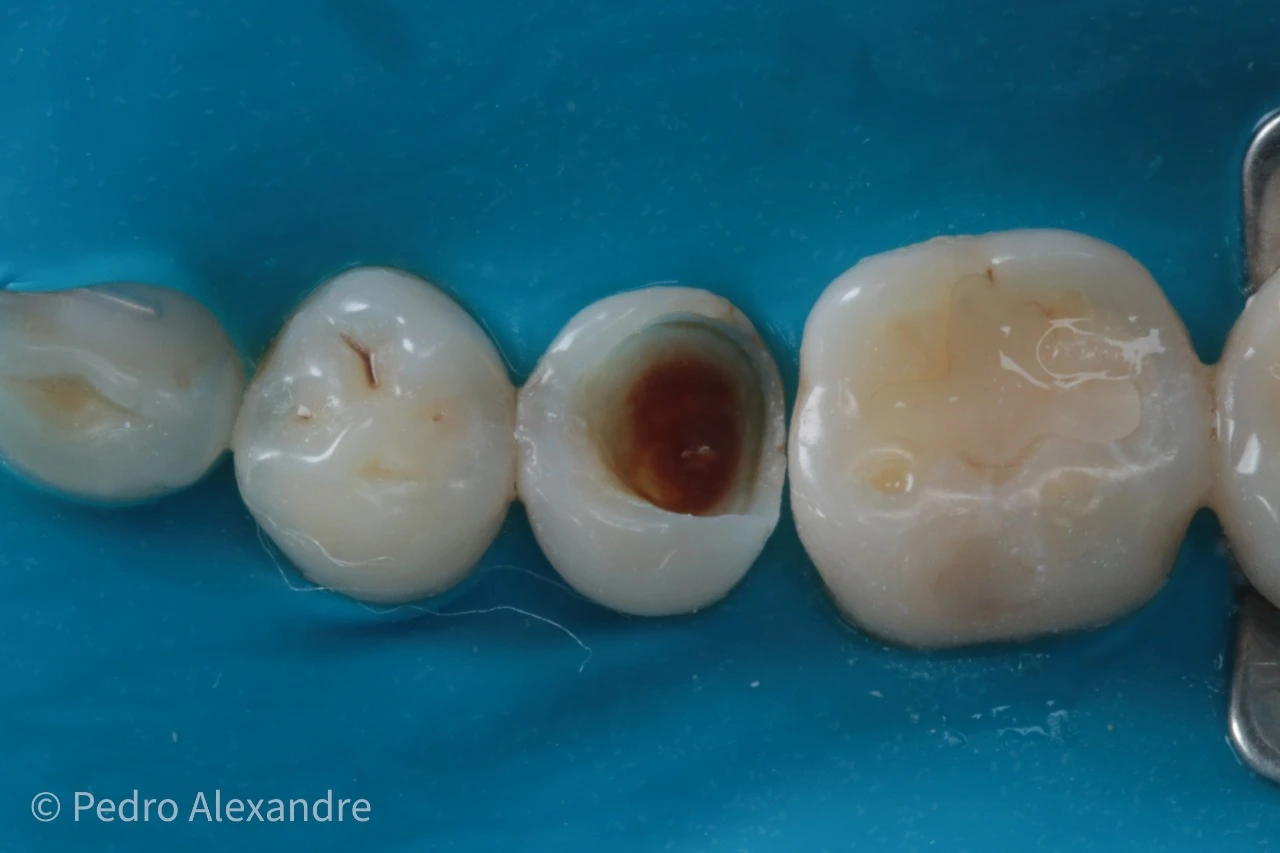Imagem de dentes com cárie, destaque para um dente com erosão e manchas marrons, em procedimento odontológico de restauração odontológica.