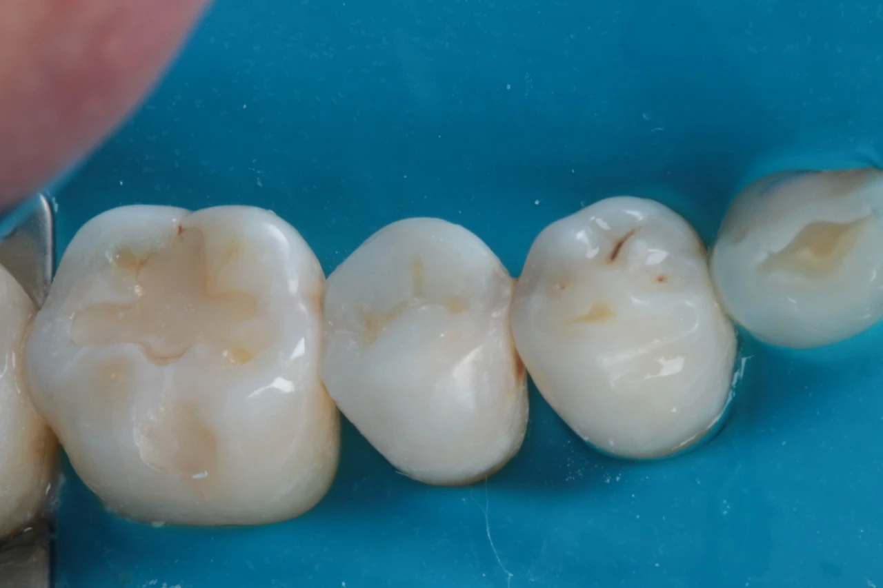 Imagem de dentes, incluindo dois molares, dois pré-molares e um molar inferior, mostrando preparação para restauração ou colocação de coroas.