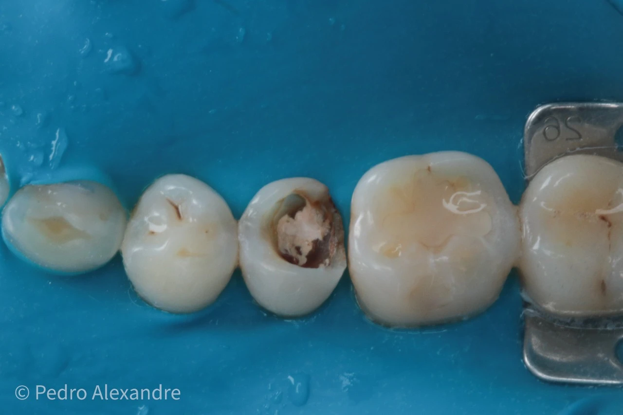 Imagem de dentes tratados com cárie, mostrando diferentes fases de restauração odontológica, com foco em saúde bucal e procedimentos dentários.