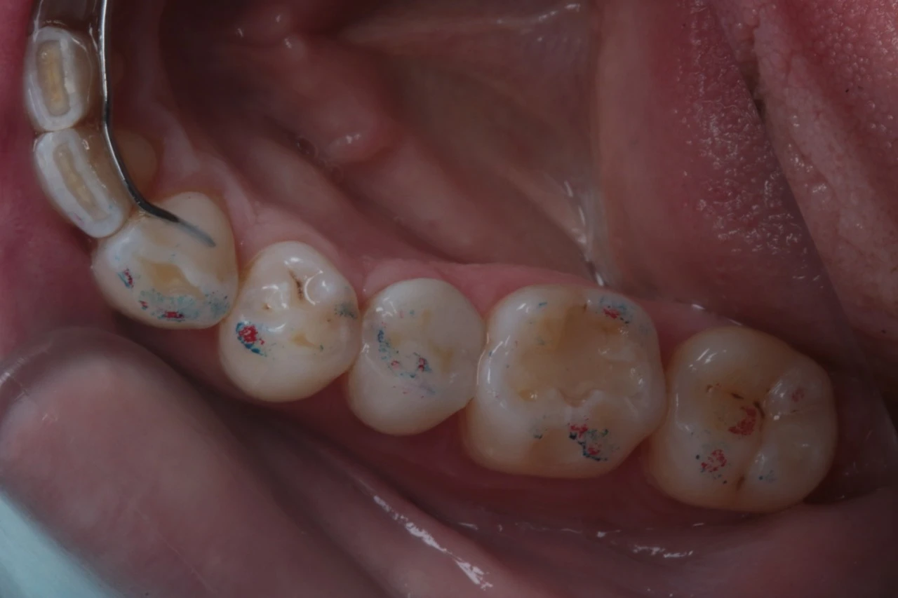 Vista interna de molares com marcas de fidelidade em esmalte, possivelmente para tratamento odontológico ou ortodôntico.