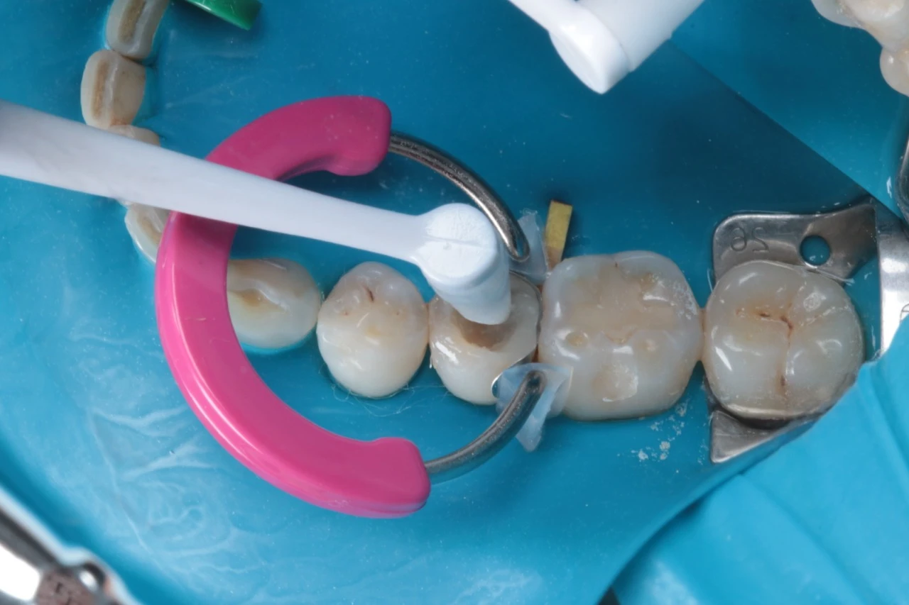 Procedimento odontológico com espelho, instrumentos e resinas na boca de um paciente, ilustrando cuidados dentários.