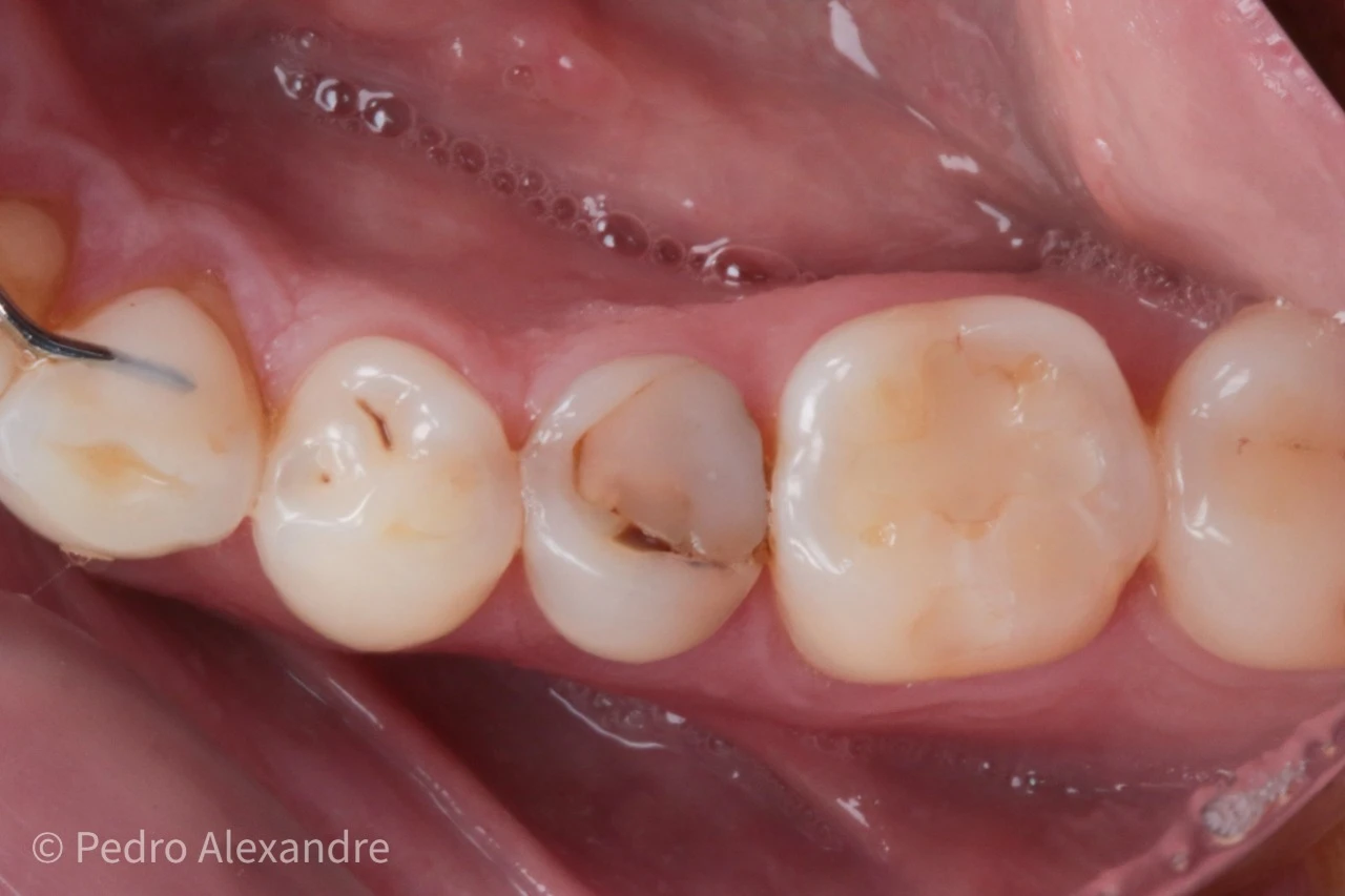 Imagem de um procedimento odontológico mostrando dentes com cáries e restaurações em uma boca, com foco na região posterior dos molares.