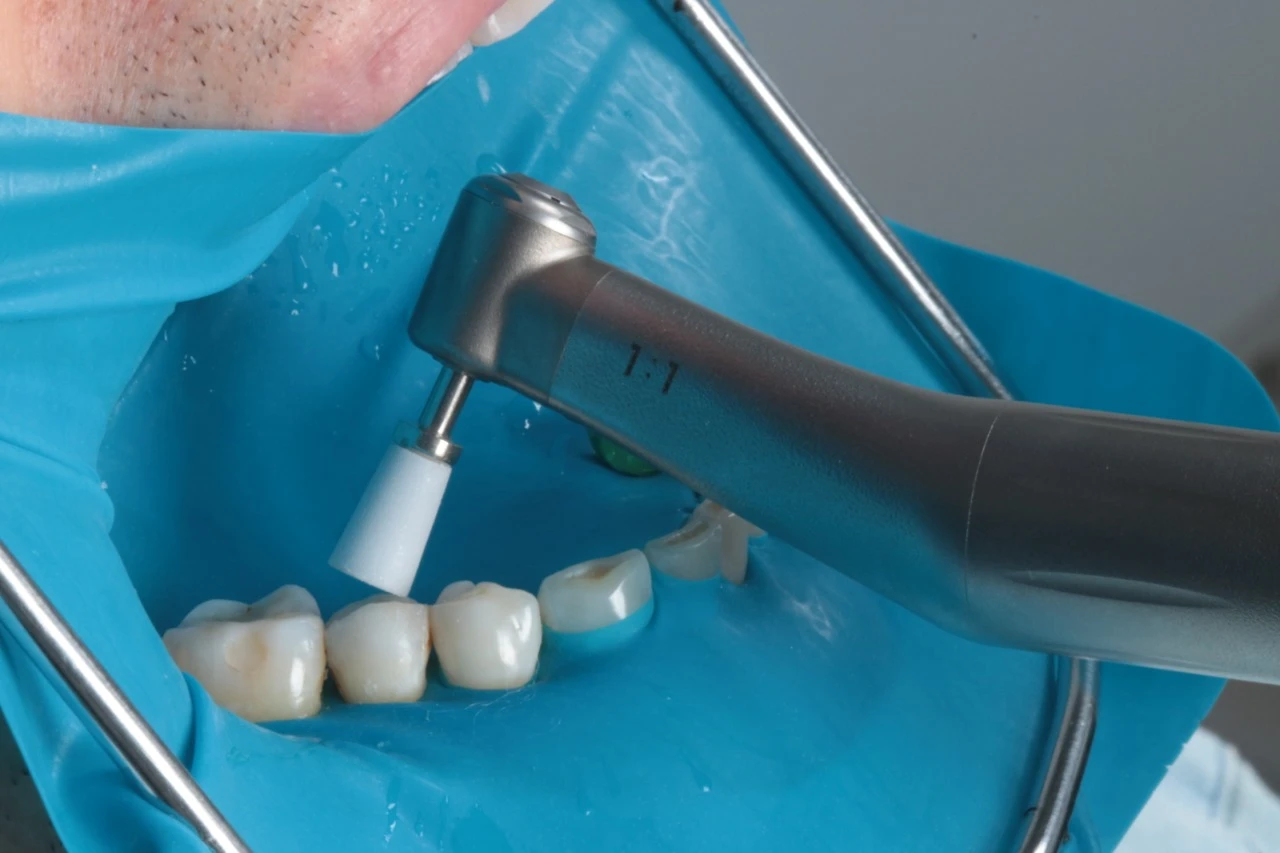Procedimento odontológico de aplicação de laser em dentes, com equipamento especializado e proteção adequada, realizado por profissional de odontologia.