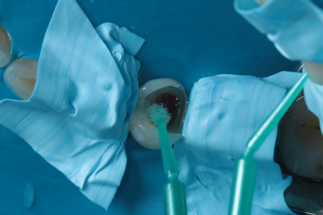 Procedimento odontológico com escova de limpeza dentro da cavidade bucal, realizada por profissional de saúde bucal com luvas e instrumentos médicos, na clínica odontológica.