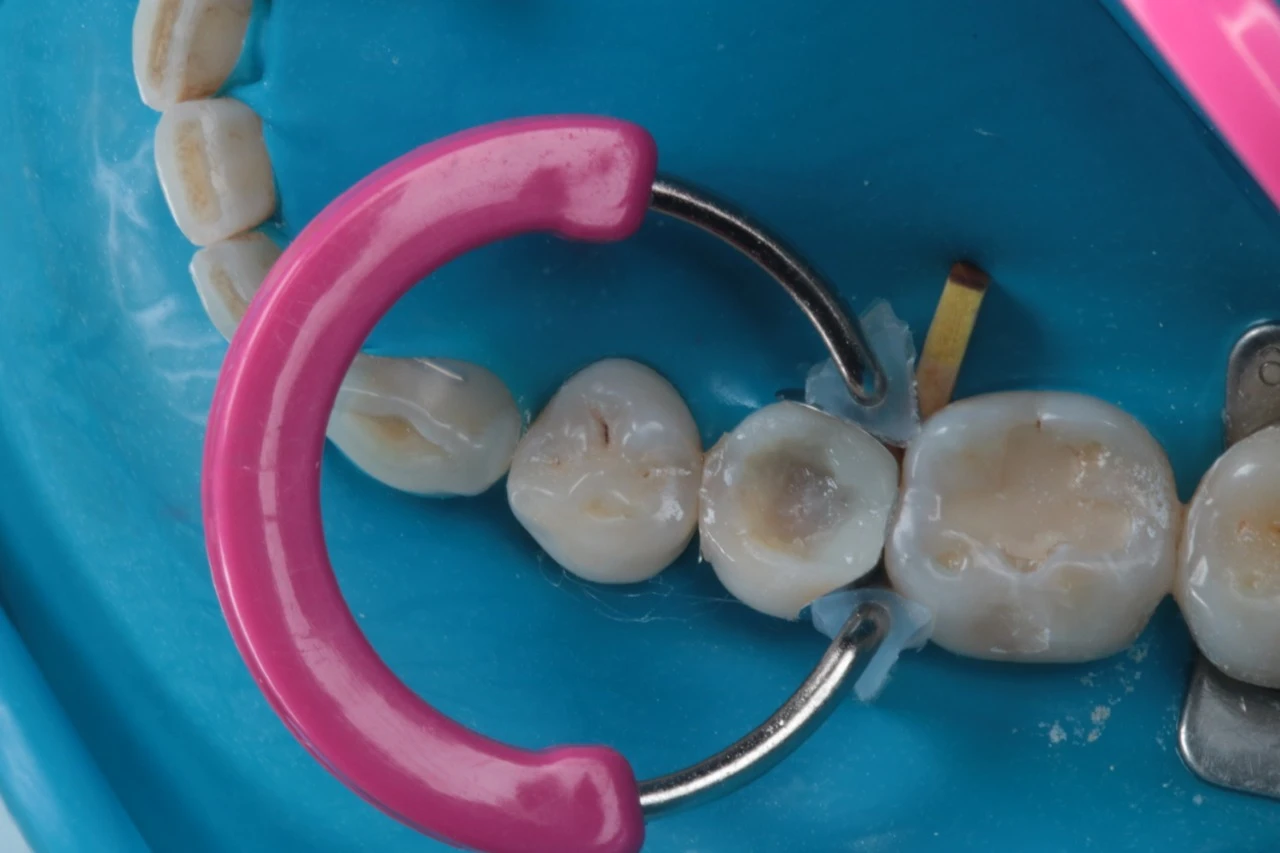 Tratamento de canal em dentes com carie, utilizando instrumentos odontológicos como lima e mola para limpeza e preenchimento do canal.