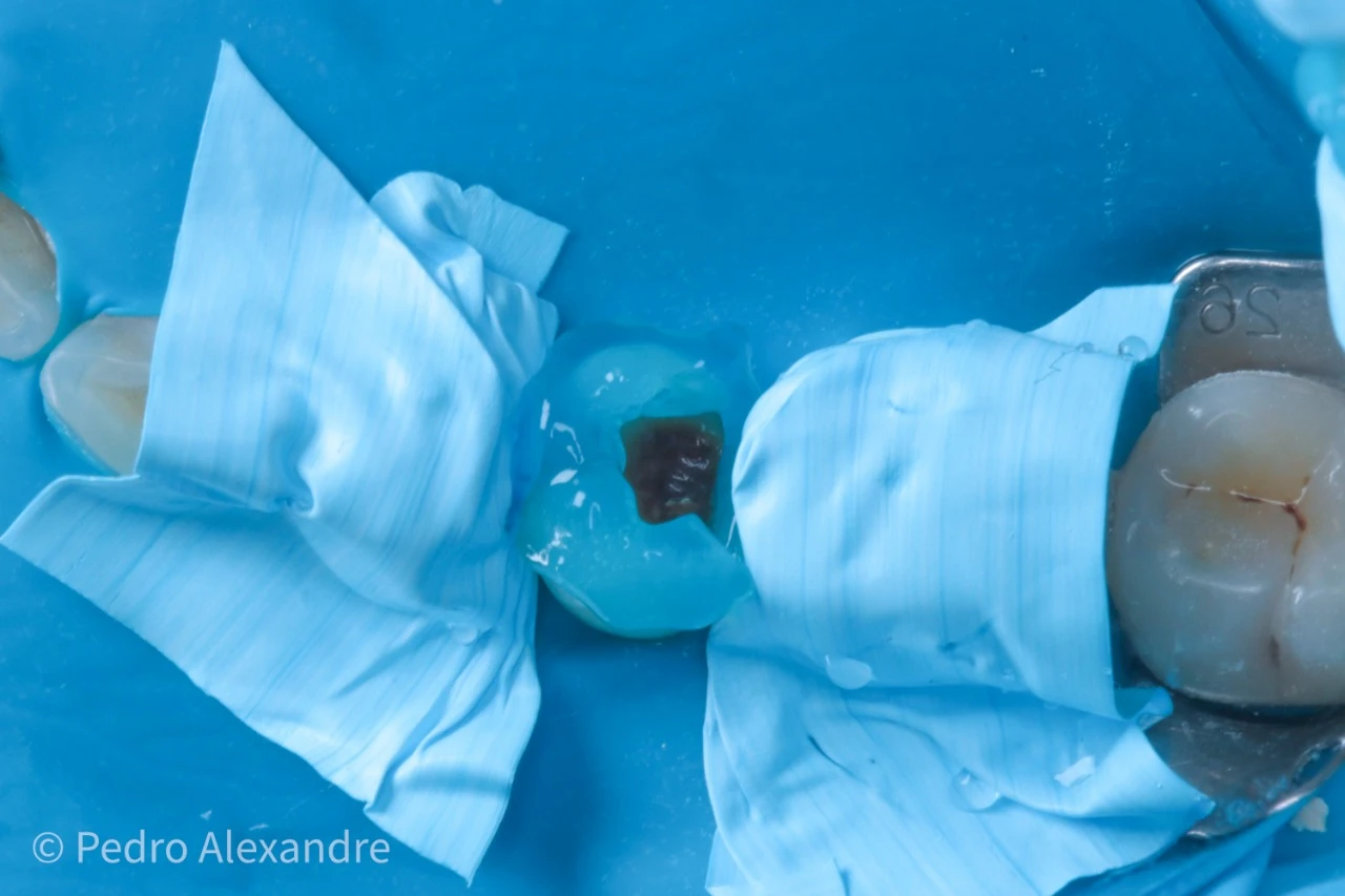 Tratamento de canal em dente com obturação, procedimento odontológico detalhado em ambiente clínico, foco na saúde bucal e cuidados com dentes.
