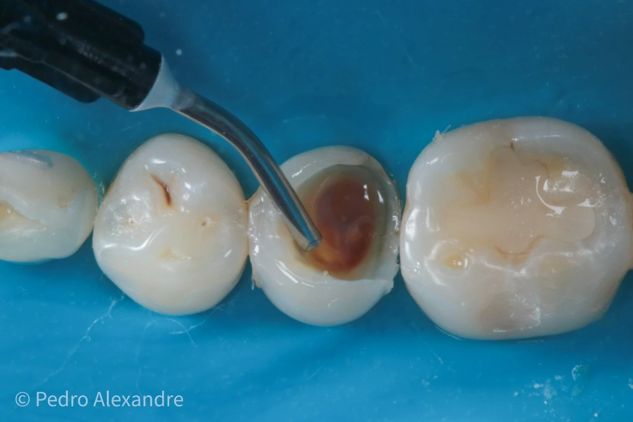 Procedimento de tratamento de cárie em dentes molares com uso de instrumentos odontológicos, ilustrando cuidados com a saúde bucal e prevenção de problemas dentários.