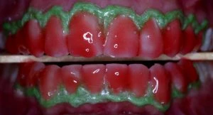 Imagem de uma boca com clareamento dental em ambas as arcadas e gengiva rosa, refletida em uma superfície úmida, com detalhes no sorriso e textura da gengiva.