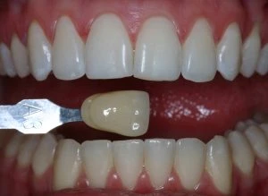 Imagem de uma pessoa recebendo um procedimento de clareamento dental para melhorar o sorriso, destacando dentes brancos e estéticos.