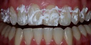 Imagem mostrando dentes brancos e bem cuidados, com gengivas saudáveis e sorriso bonito, ideal para promover cuidados odontológicos e tratamentos dentários.