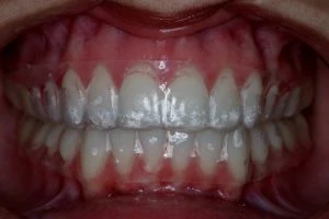 Imagem de dentes com problemas de higiene bucal, incluindo placa e gengivite, demonstrando a importância de cuidados bucais regulares para a saúde dental.