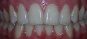 Imagem de dentes com sorriso saudável, apresentando alinhamento adequado e gengivas em bom estado de saúde, refletindo higiene bucal eficiente.