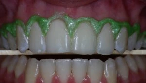 Imagem de uma limpeza dental com barreira gengival em volta dos dentes, destacando procedimentos de higiene bucal para um sorriso mais saudável.