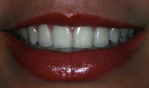 Sorriso com dentes brancos e brilhantes, destacando cuidado bucal e estética dental. Imagem que evidencia uma boca bem cuidada e aparência saudável.