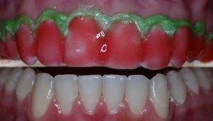 Imagem de sorriso com dentes alvos e gengivas saudáveis, destacando uma boa higiene bucal, ideal para quem busca dicas de saúde dental e estética oral.