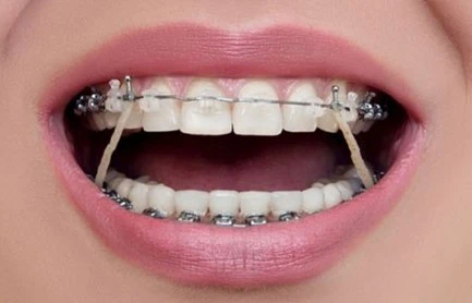 Sorriso com aparelhos ortodônticos, mostrando dentes alinhados e estética aprimorada na orthopedia dentária para um sorriso perfeito.