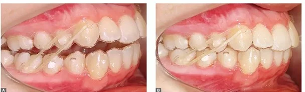 Imagem mostrando antes e depois de tratamento de alinhamento dental, destacando a melhora na posição dos dentes usando aparelho ortodôntico.