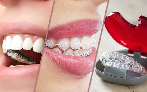 Imagem que mostra diferentes etapas de tratamento ortodôntico, incluindo aparelho, alinhadores transparentes e sorridente saudável, promovendo saúde bucal.