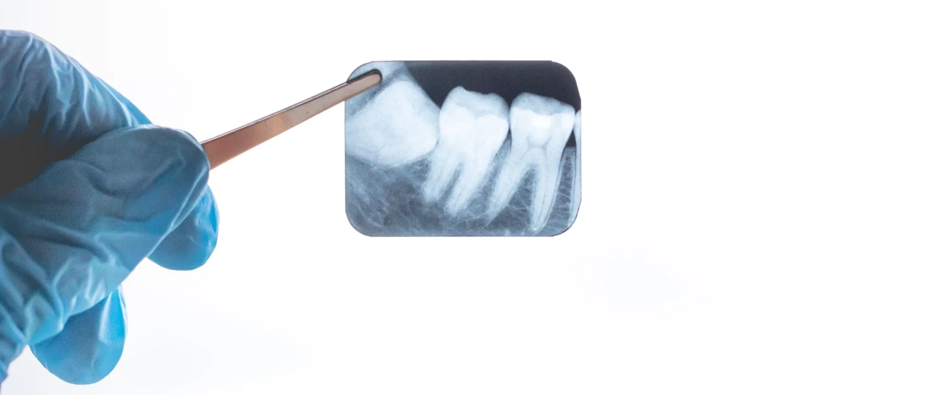 Radiografia dentária sendo analisada com pinça, mostrando detalhes da saúde bucal. Importante para diagnósticos de problemas dentários.