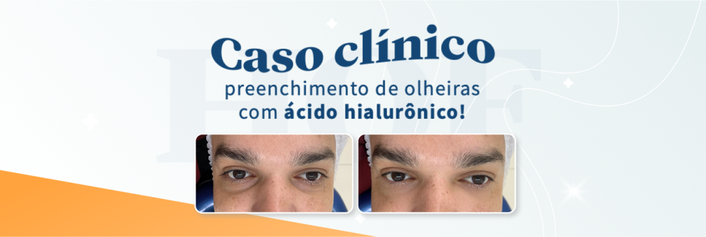 caso clínico de preenchimento de olheiras com ácido hialurônico de baixa viscosidade